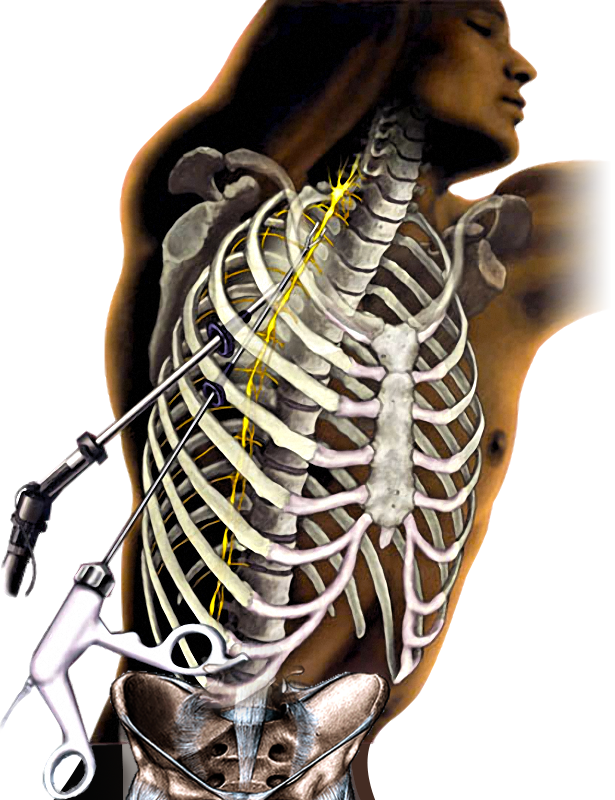 simpactetomia800px_1